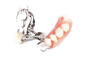 インプラント・ブリッジ・入れ歯の比較