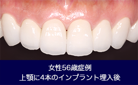 天然歯に限りなく近いインプラント