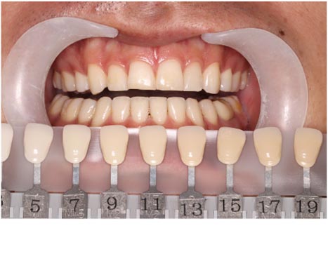 トランセントフラッシュホワイトニング1回照射(10分）の症例（治療前）